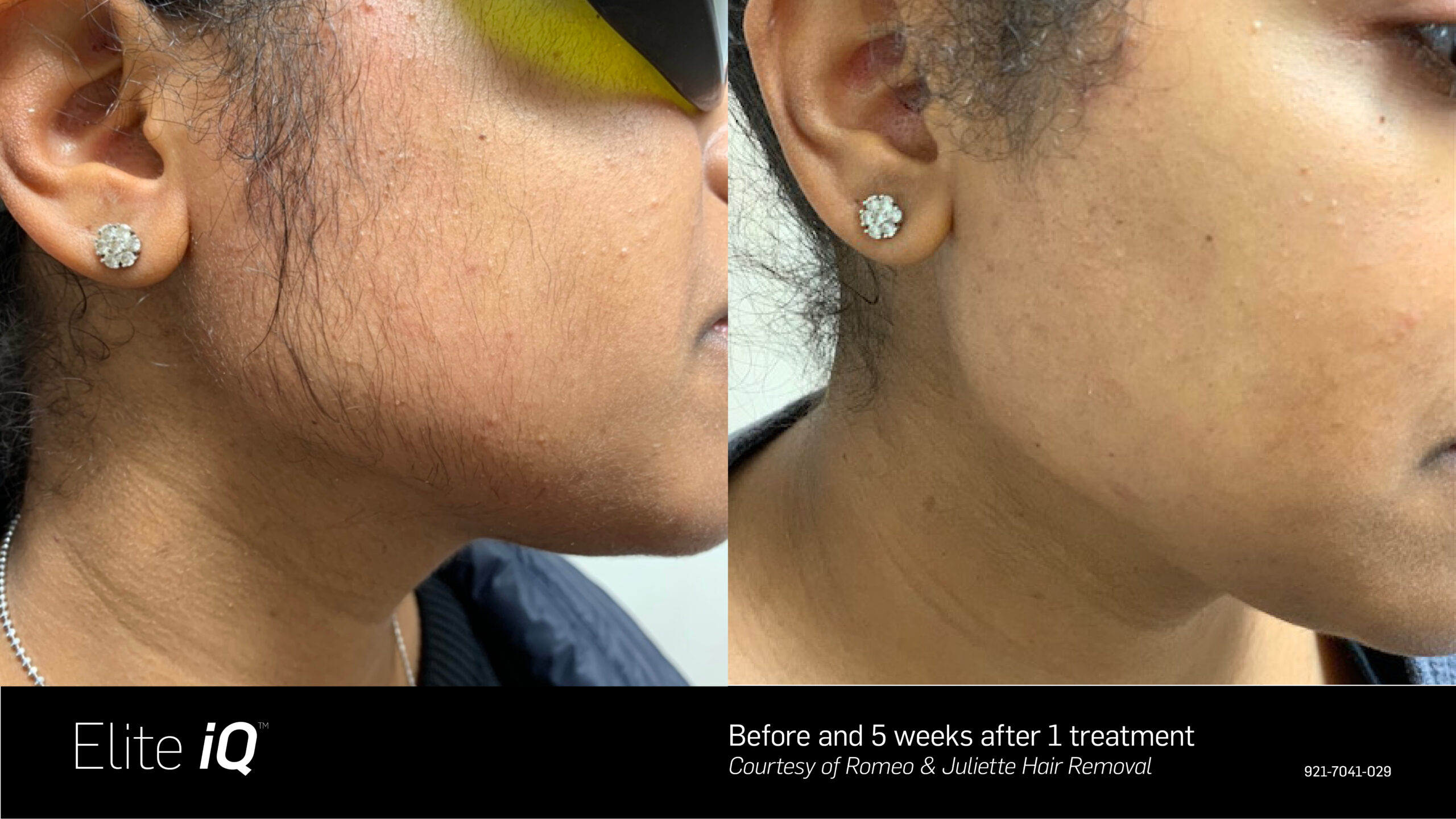 Elite iQ B&A 7 - Hair Removal