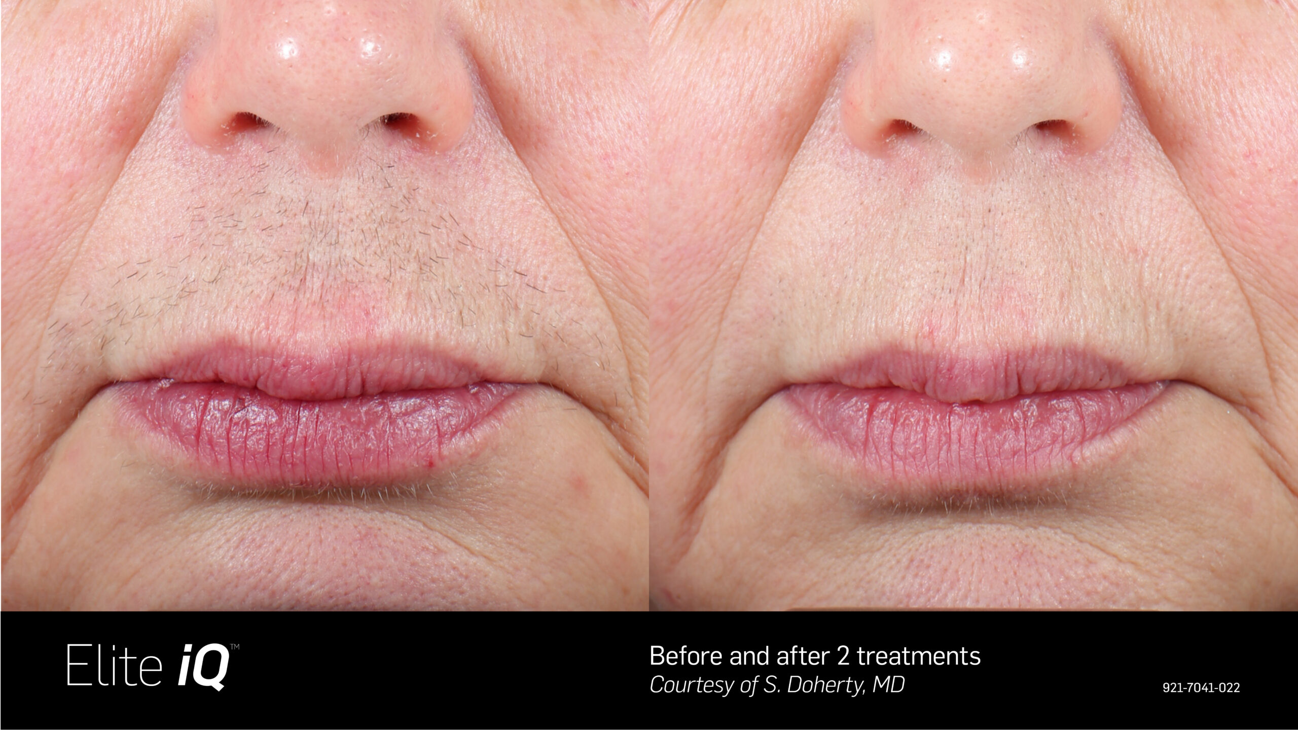 EliteiQ BA 3 HR USA-EN